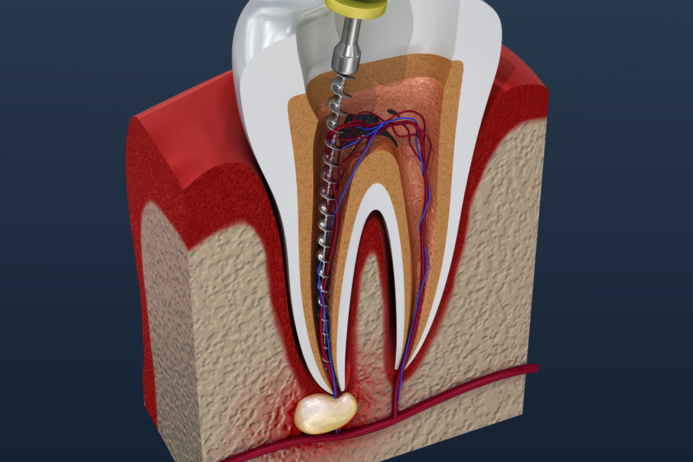 Dental Implants Manchester