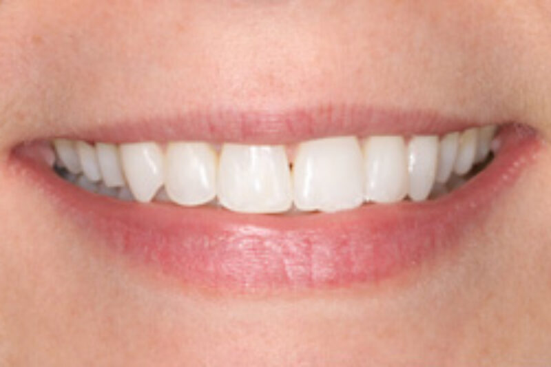 After - Cheadle Hulme Dental