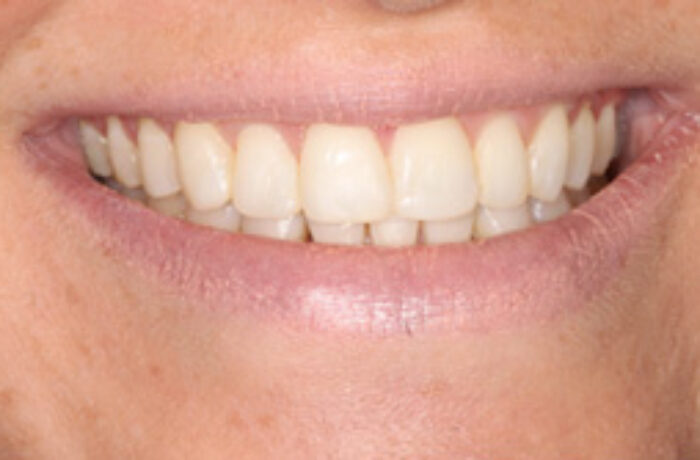 After - Cheadle Hulme Dental