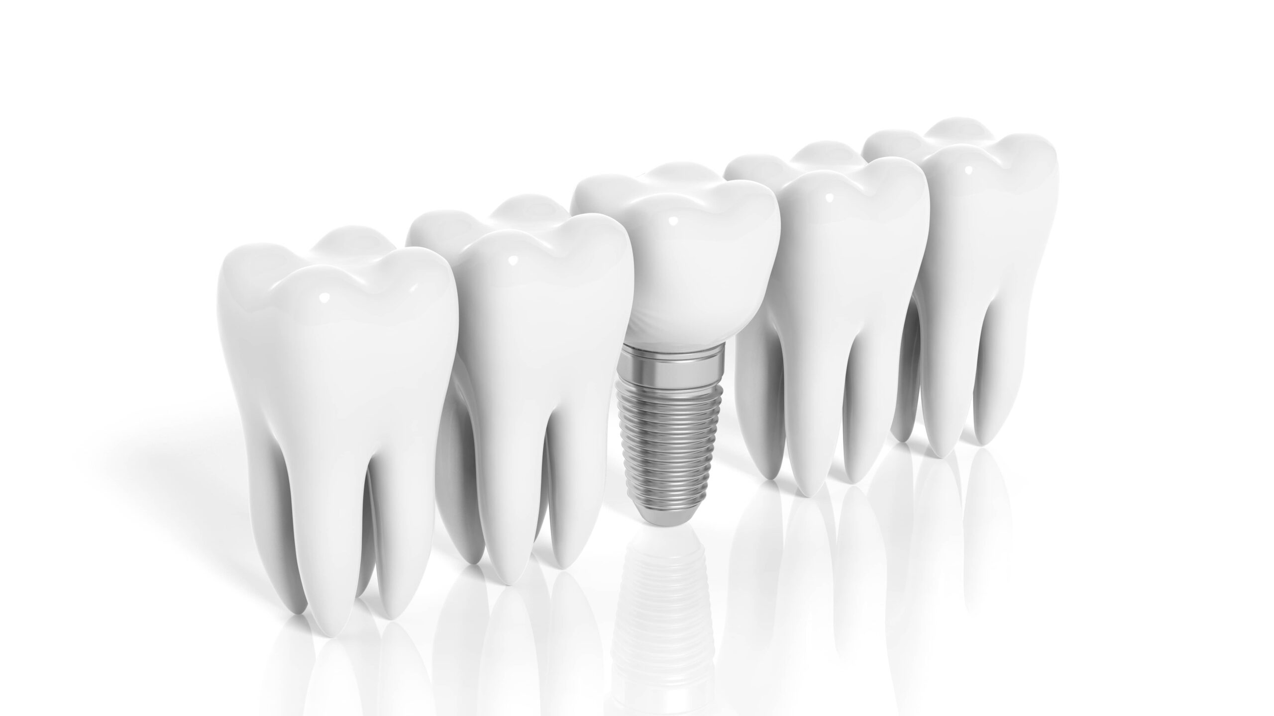 How Dental Implants Manchester Are Used To Secure Dentures