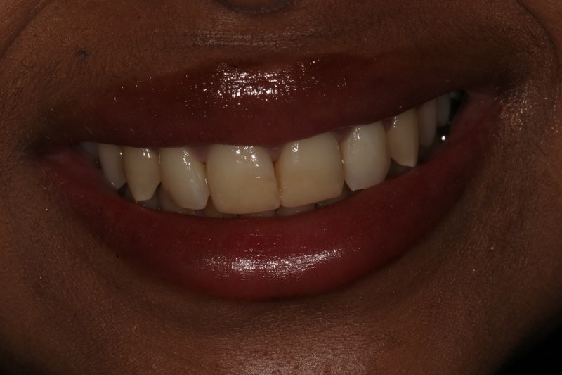 After - Cheadle Hulme Dental