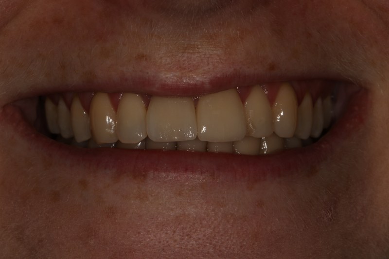 After - Cheadle Hulme Dental