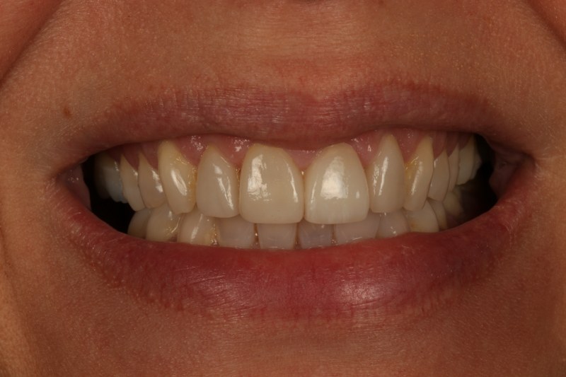 After - Cheadle Hulme Dental