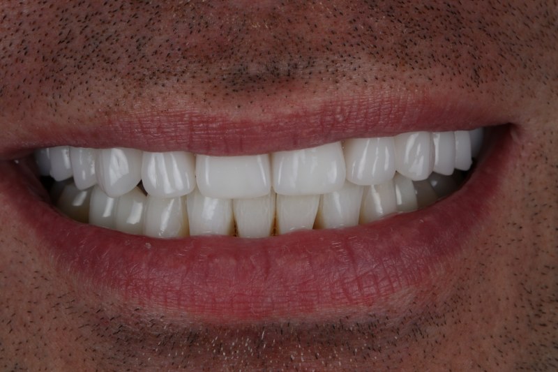 After - Cheadle Hulme Dental