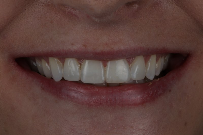 After - Cheadle Hulme Dental