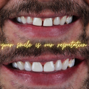 Composite Veneers Smile makeover