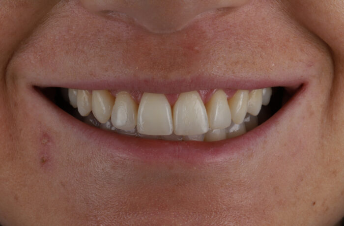 After - Cheadle Hulme Dental